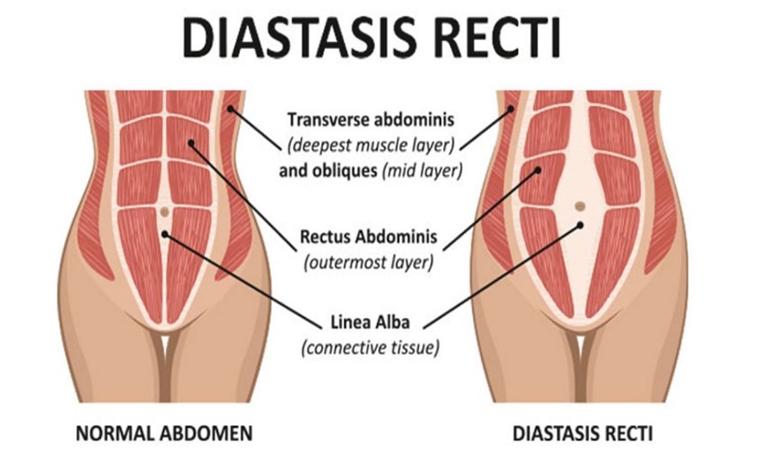 Myofascial Release And Abdominal Massage For Diastasis Recti